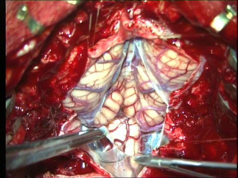 EPENDYMOMA 4TH VENTRICLE SURGERY